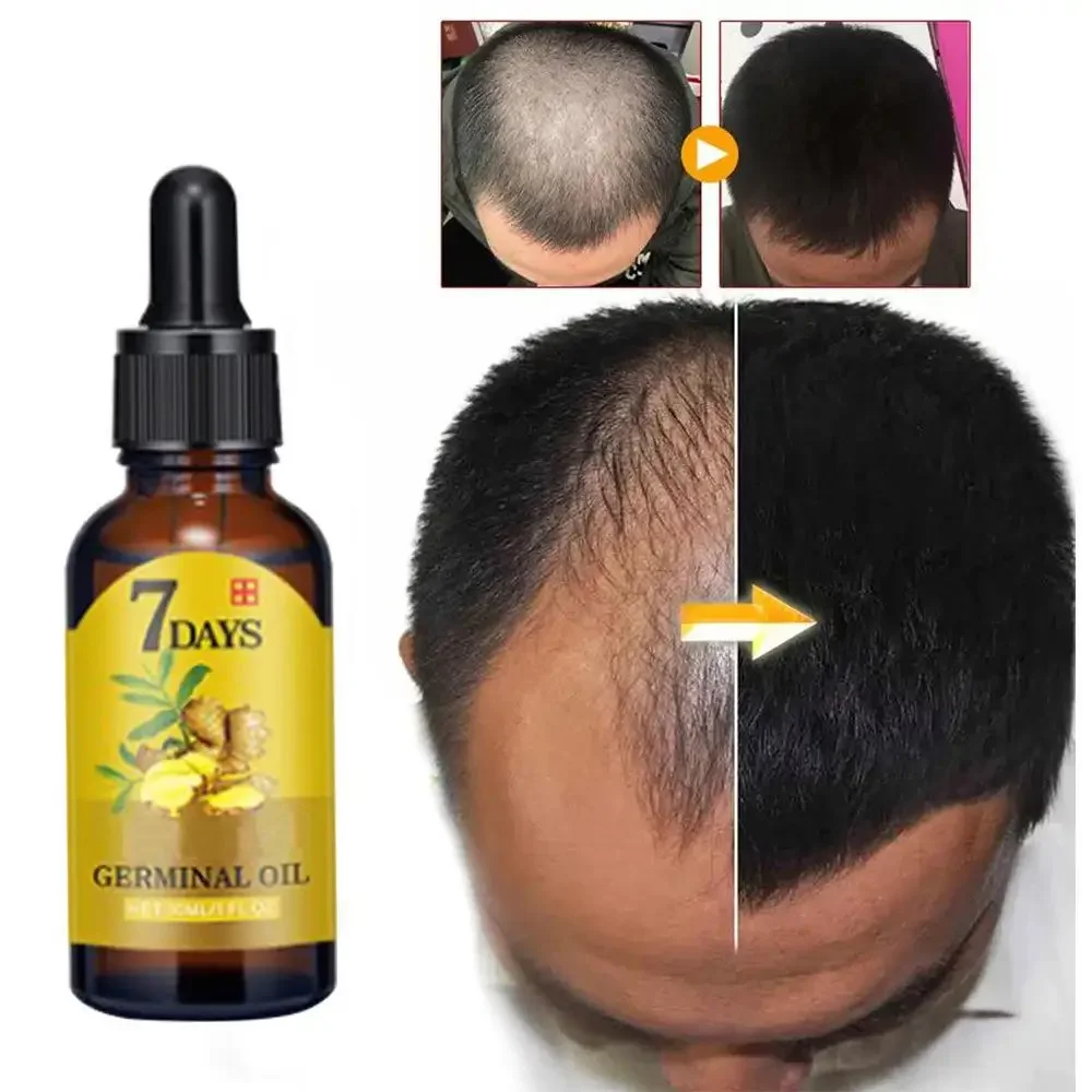 Ingrown Hair Serum - Haarwachstums-Ingwer, schnell wachsendes Haar, ätherisches Öl,